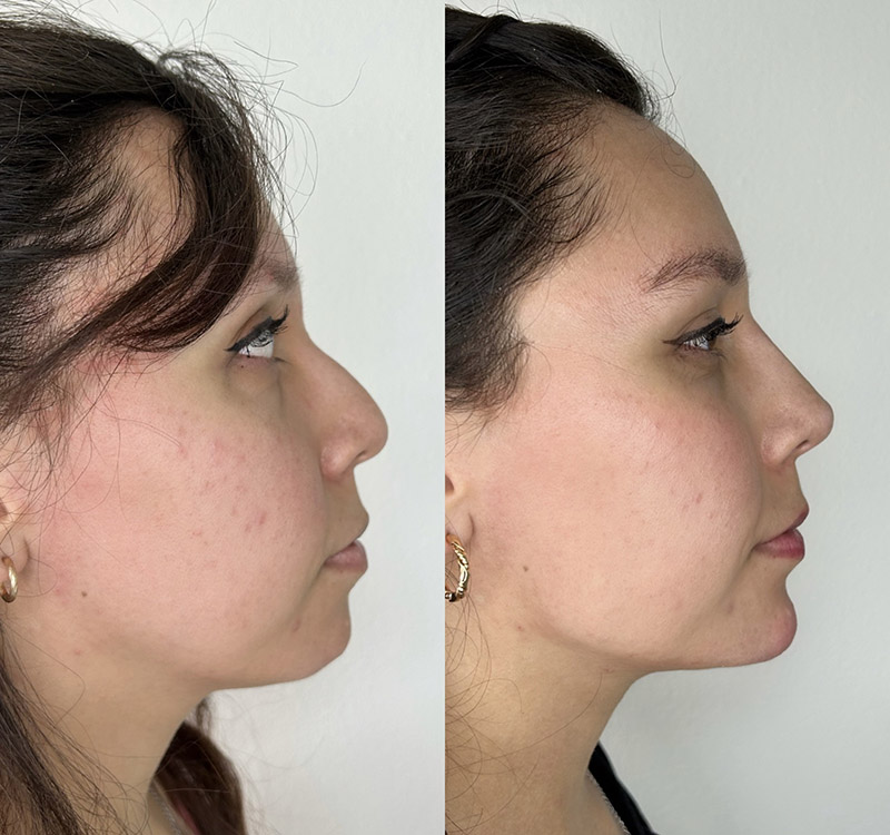 Defined Contour Nose Jawline