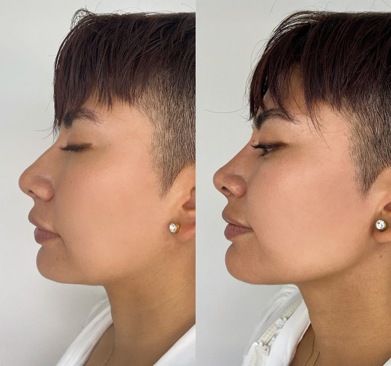 Defined Contour Nose Jawline
