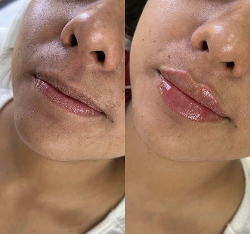 Natural Lip Enhancement