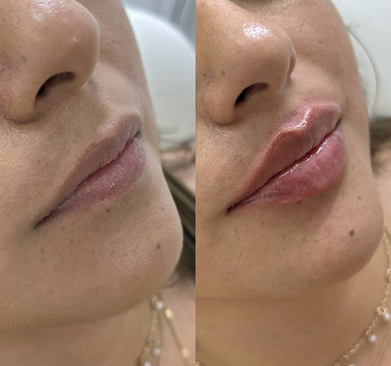 Natural Lip Enhancement