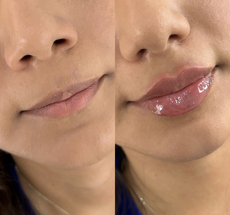 Natural Lip Enhancement