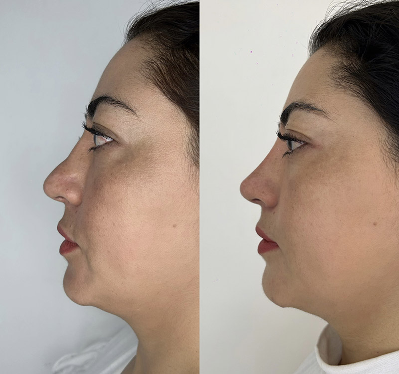 Non-surgical Rhinoplasty