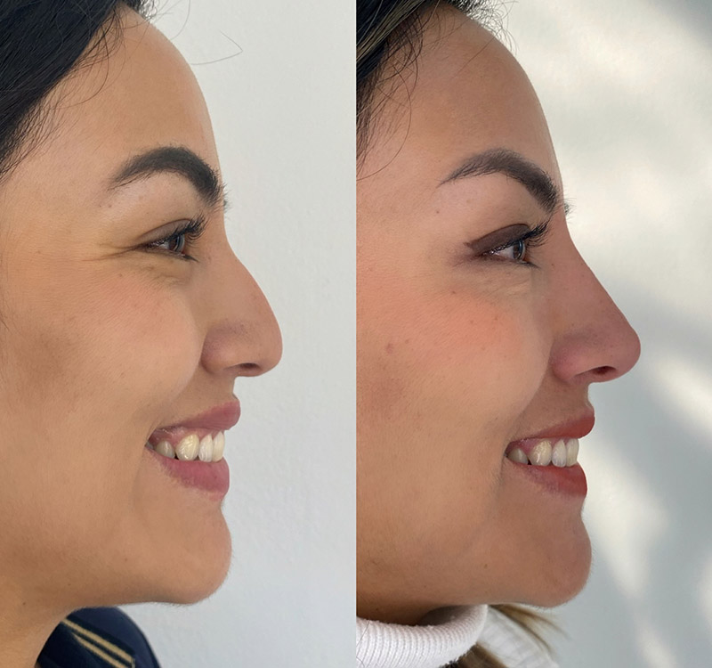 Non-surgical Rhinoplasty