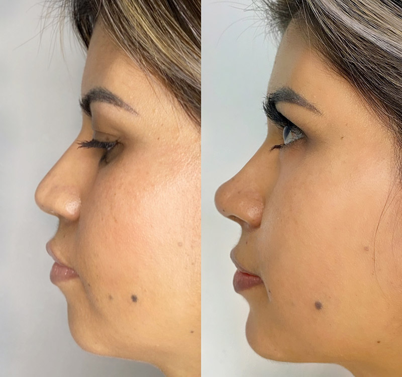 Nose + Chin Sculpted & Natural