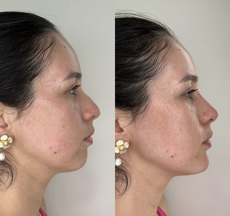 Nose + Chin Sculpted & Natural