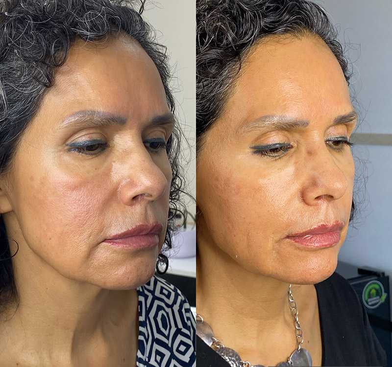 Progressive rejuvenation with biostimulators