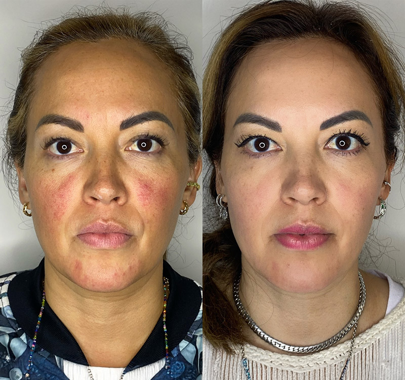 Rosacea under control