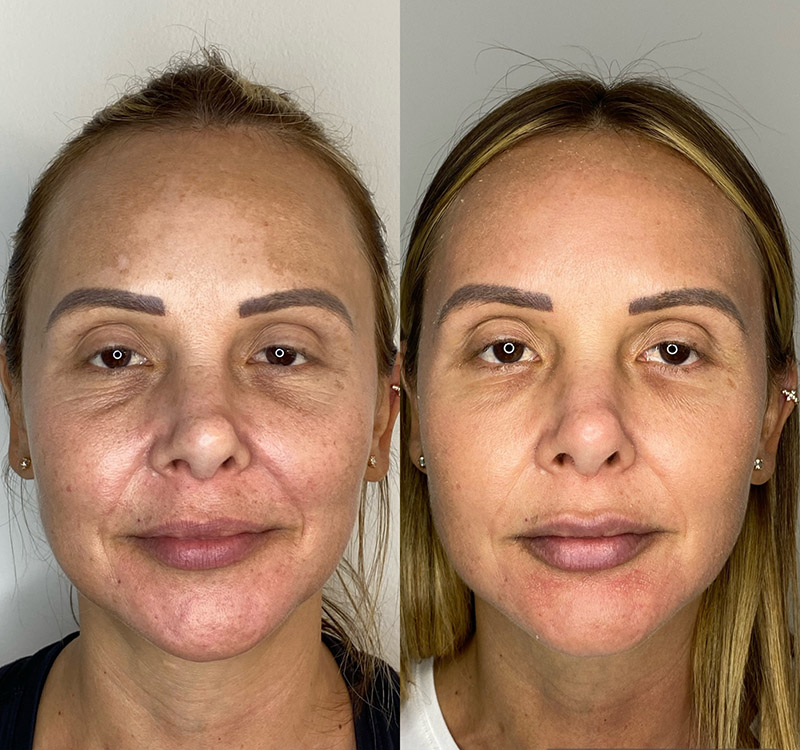 Skin brightening journey