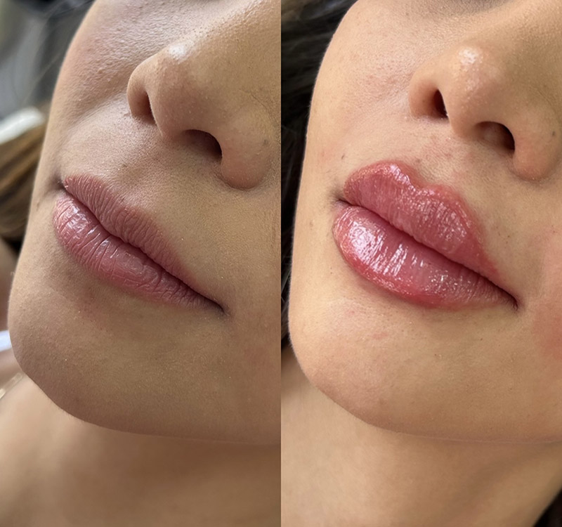 Voluminous Lips