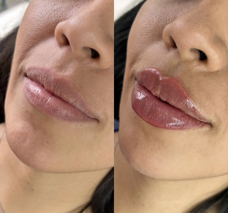 Voluminous Lips