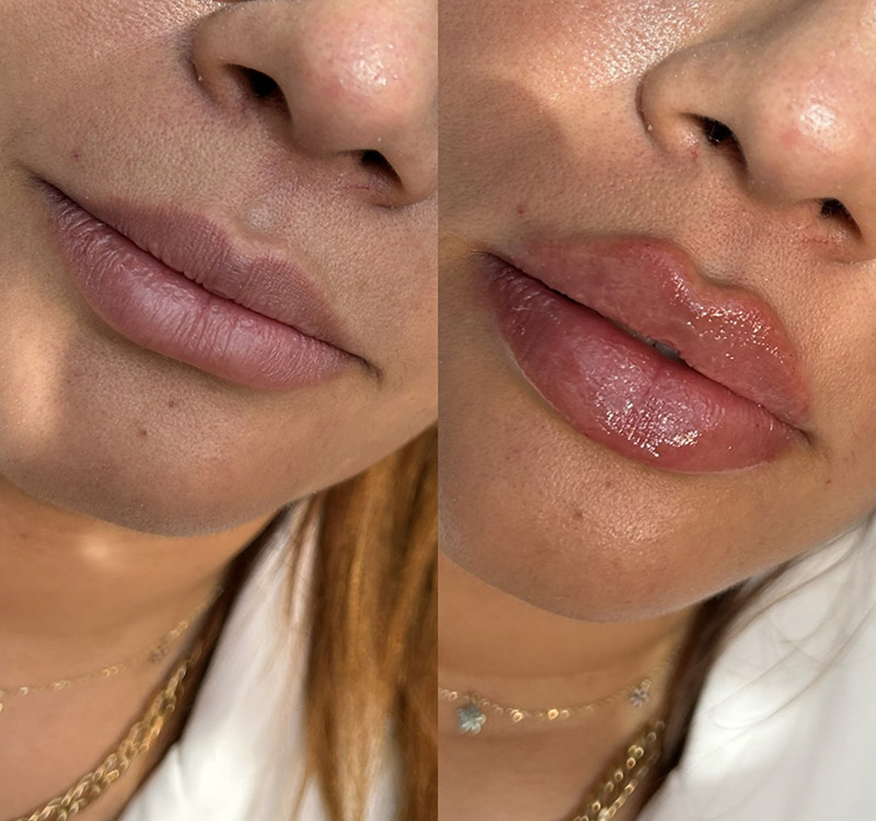 Voluminous Lips
